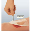 Cuticerin Impregnated Dressing (66045502), 25 EA/BX, 6BX/CS